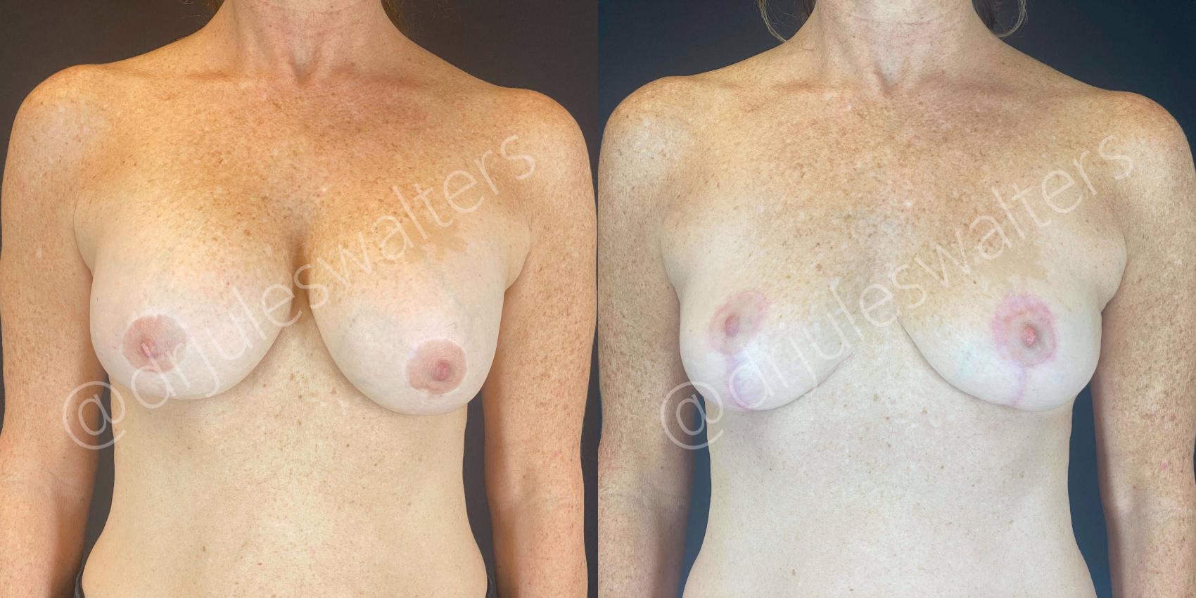 Before & After Breast Lift Case 109 View #1 View in Metairie, New Orleans, Covington, LA
