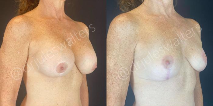 Before & After Breast Revision Case 109 View #2 View in Metairie and New Orleans, LA