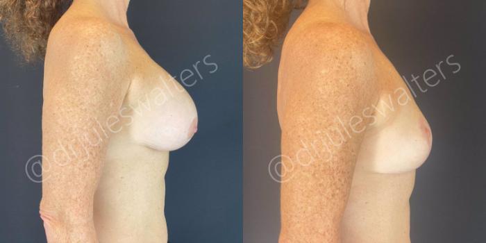 Before & After Breast Revision Case 109 View #3 View in Metairie and New Orleans, LA