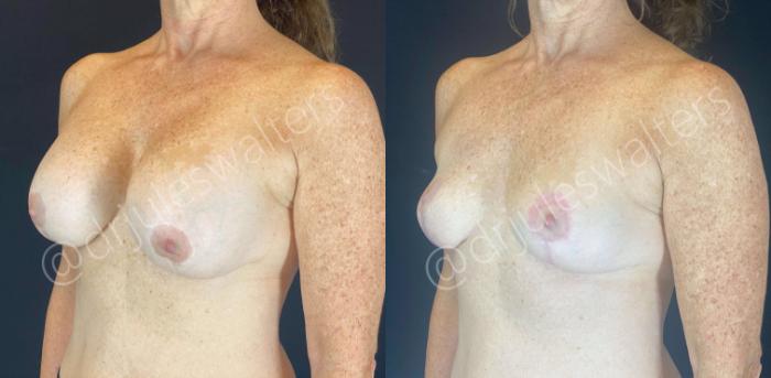 Before & After Breast Revision Case 109 View #4 View in Metairie and New Orleans, LA