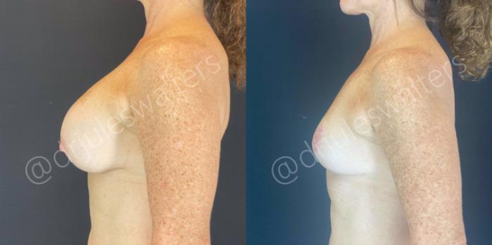 Before & After Breast Lift Case 109 View #5 View in Metairie and New Orleans, LA