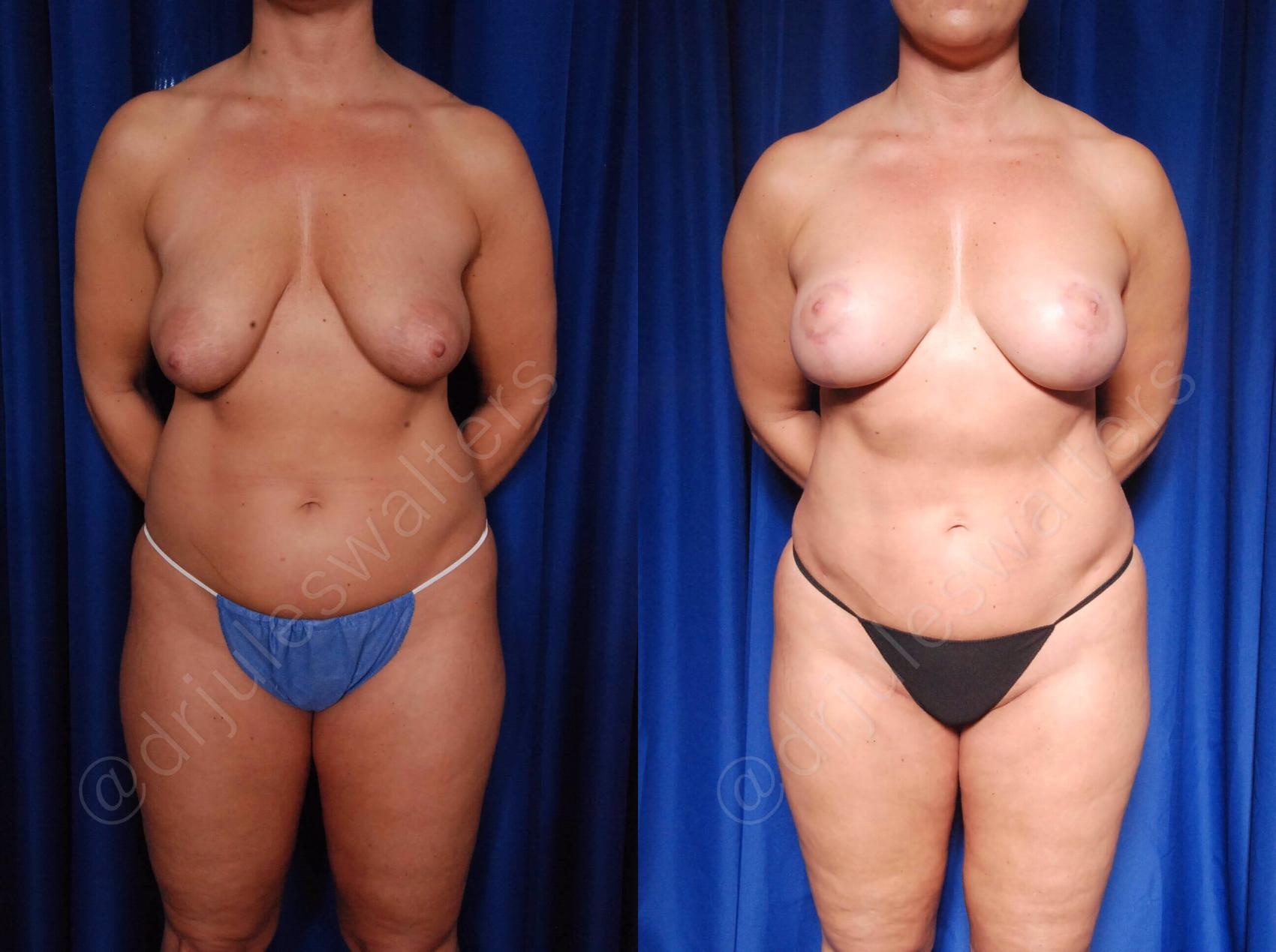 Before & After Breast Lift Case 111 View #1 View in Metairie and New Orleans, LA