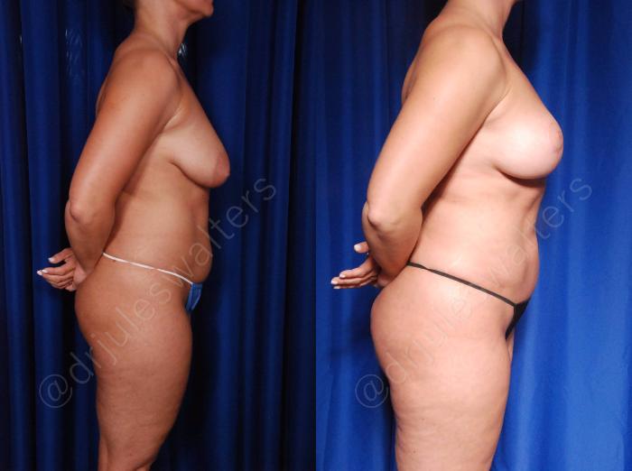 Before & After Breast Lift Case 111 View #5 View in Metairie and New Orleans, LA