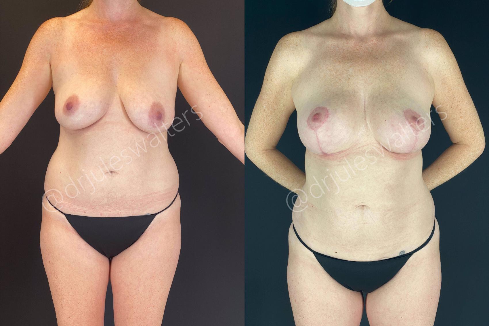 Before & After Breast Lift Case 113 View #1 View in Metairie, New Orleans, Covington, LA