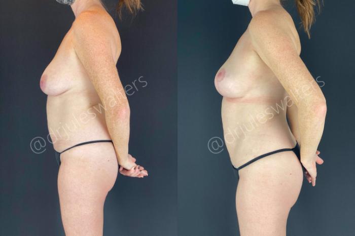 Before & After Breast Lift Case 113 View #2 View in Metairie and New Orleans, LA