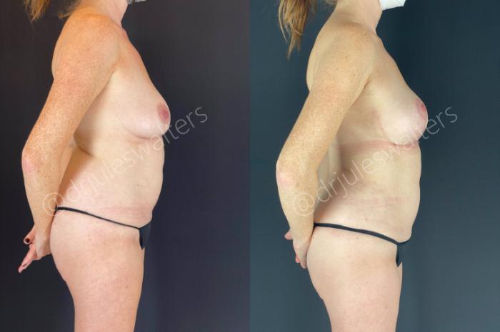 Before & After Breast Lift Case 113 View #3 View in Metairie and New Orleans, LA
