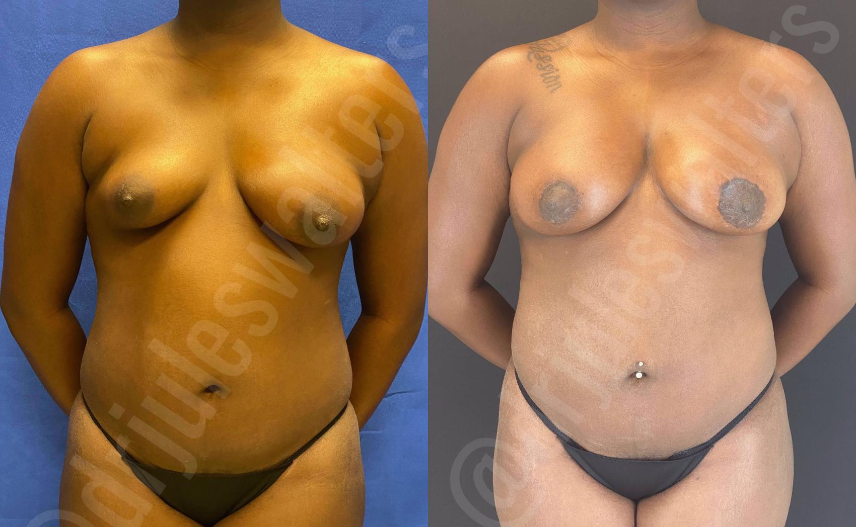 Before & After Breast Lift Case 114 View #1 View in Metairie, New Orleans, Covington, LA