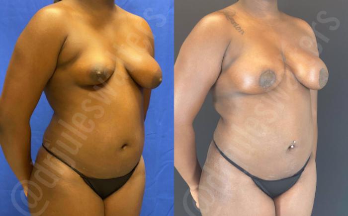 Before & After Liposuction Case 114 View #2 View in Metairie and New Orleans, LA