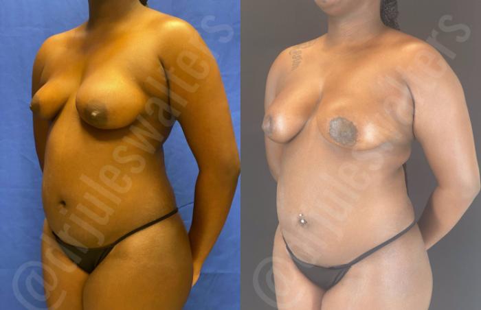 Before & After Liposuction Case 114 View #3 View in Metairie and New Orleans, LA
