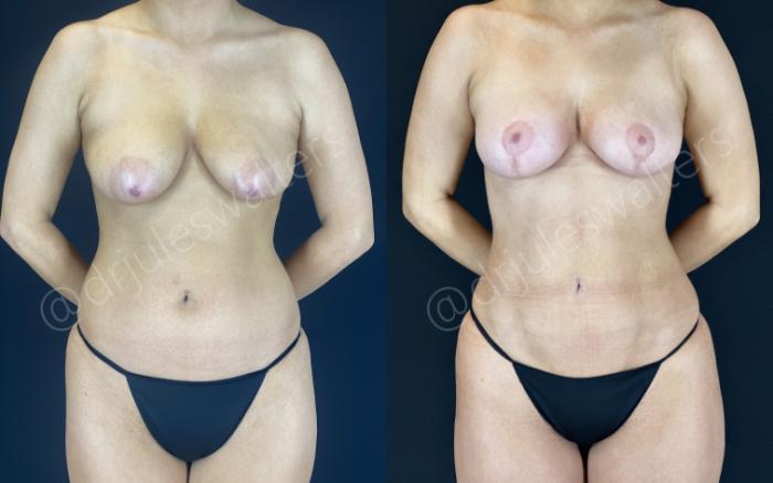 Before & After Breast Lift Case 151 Front View in Metairie and New Orleans, LA