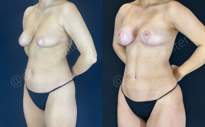 Before & After Breast Lift Case 151 Left Oblique View in Metairie and New Orleans, LA