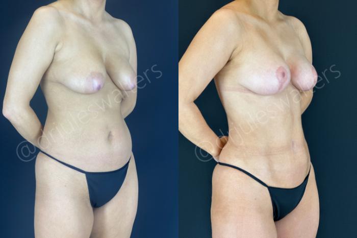 Before & After Breast Lift Case 151 Right Oblique View in Metairie and New Orleans, LA