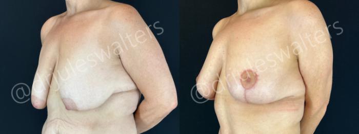 Before & After Breast Lift Case 204 Left Oblique View in Metairie and New Orleans, LA