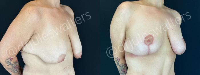 Before & After Breast Lift Case 204 Right Oblique View in Metairie and New Orleans, LA