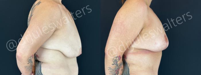 Before & After Breast Lift Case 204 Right Side View in Metairie and New Orleans, LA