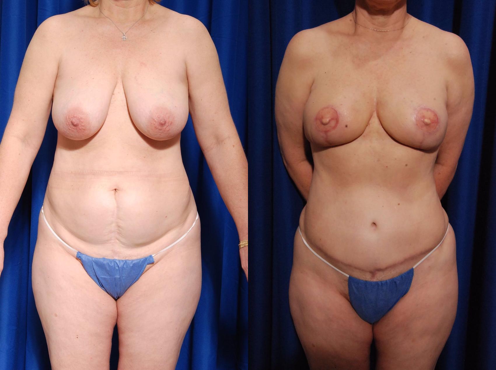 Before & After Breast Reconstruction Case 115 View #1 View in Metairie, New Orleans, Covington, LA