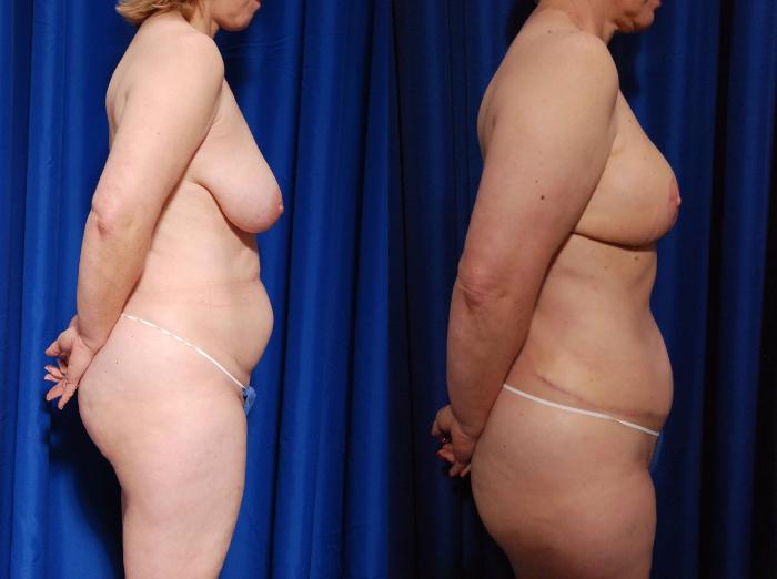 Before & After Breast Reconstruction Case 115 View #3 View in Metairie and New Orleans, LA