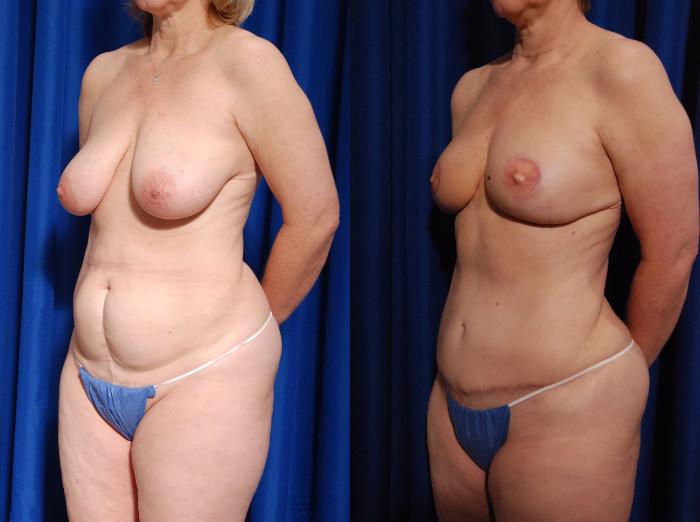 Before & After Breast Reconstruction Case 115 View #4 View in Metairie and New Orleans, LA