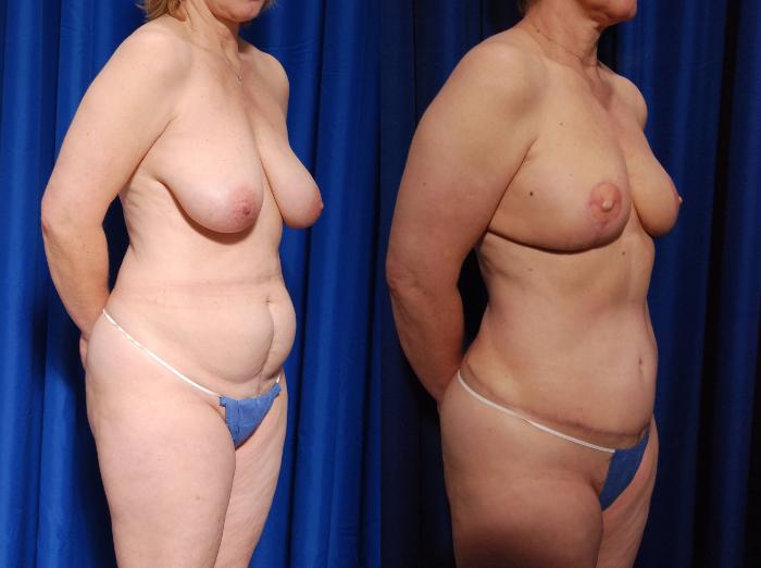Before & After Breast Reconstruction Case 115 View #5 View in Metairie and New Orleans, LA