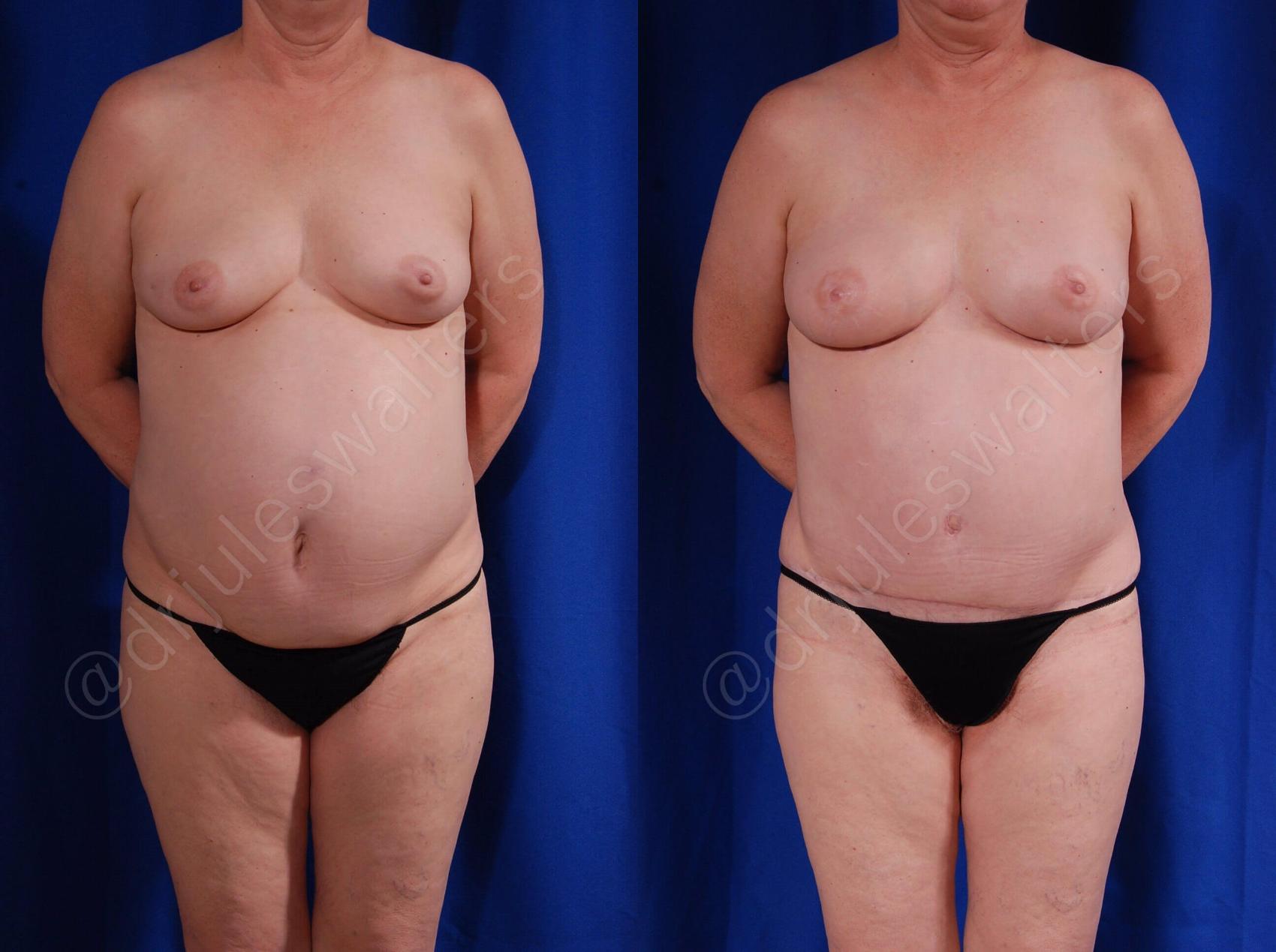 Before & After Breast Reconstruction Case 116 View #1 View in Metairie, New Orleans, Covington, LA
