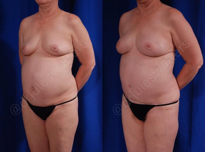 Before & After Breast Reconstruction Case 116 View #2 View in Metairie and New Orleans, LA