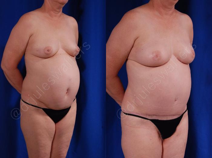 Before & After Breast Reconstruction Case 116 View #3 View in Metairie and New Orleans, LA