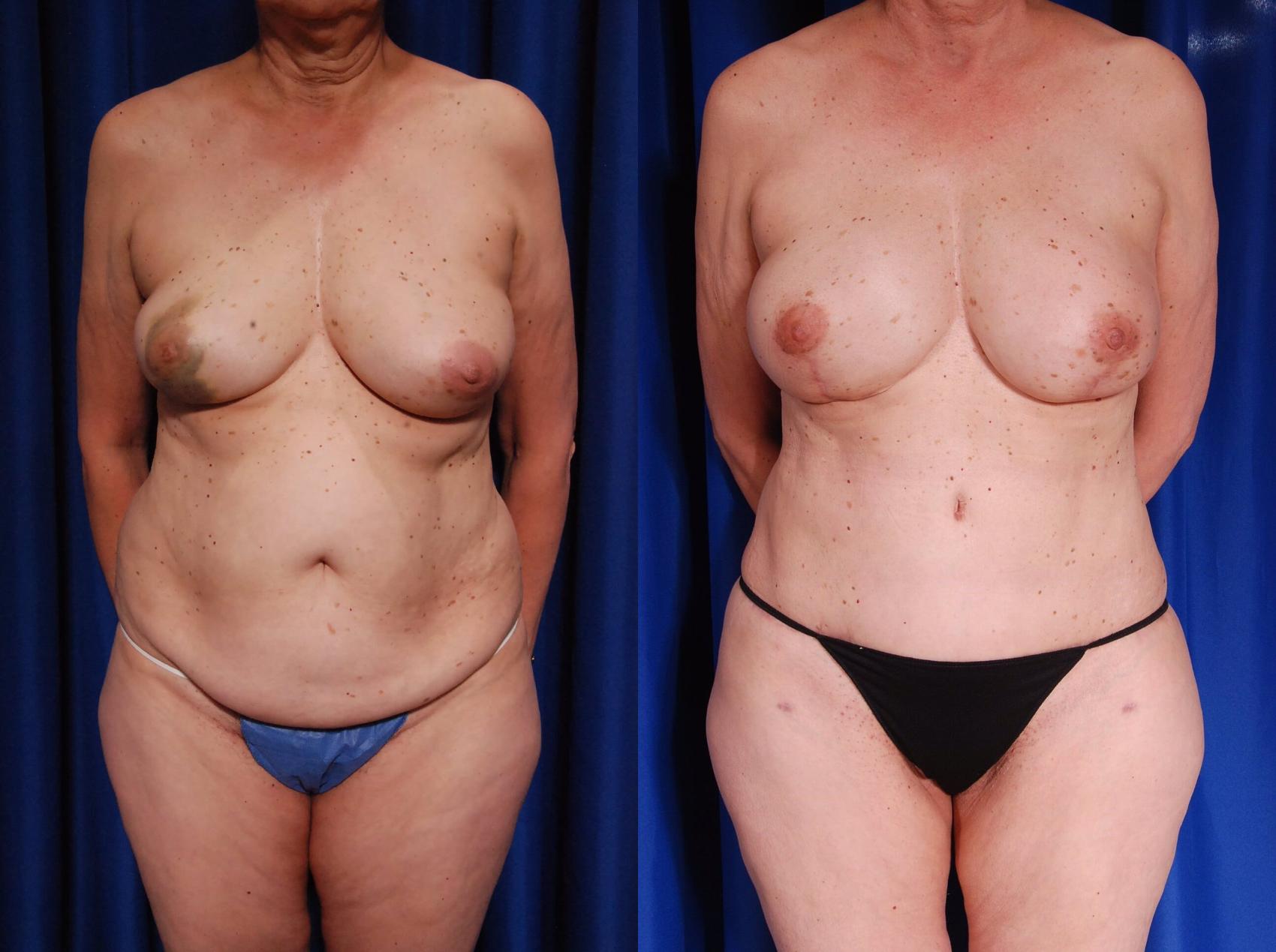 Before & After Breast Reconstruction Case 117 View #1 View in Metairie, New Orleans, Covington, LA