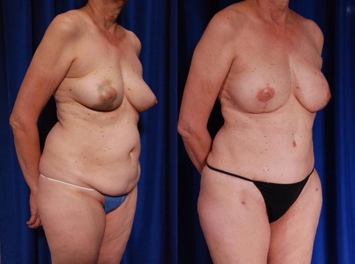 Before & After Breast Reconstruction Case 117 View #2 View in Metairie and New Orleans, LA