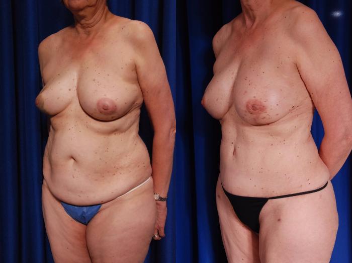 Before & After Breast Reconstruction Case 117 View #3 View in Metairie and New Orleans, LA