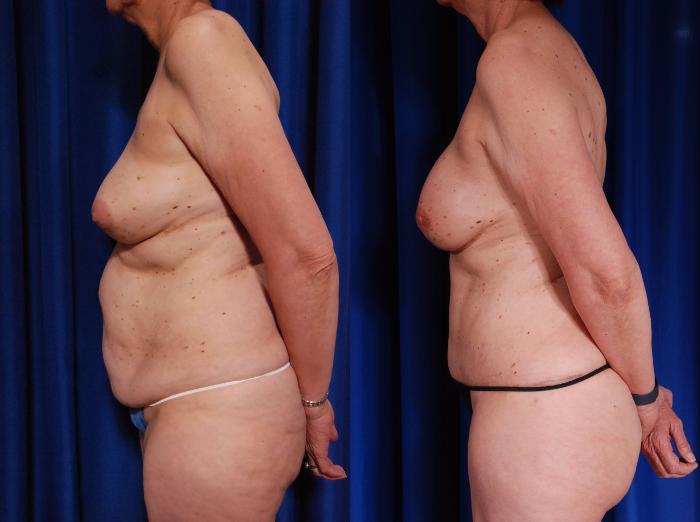 Before & After Breast Reconstruction Case 117 View #4 View in Metairie and New Orleans, LA