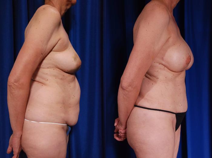 Before & After Breast Reconstruction Case 117 View #5 View in Metairie and New Orleans, LA