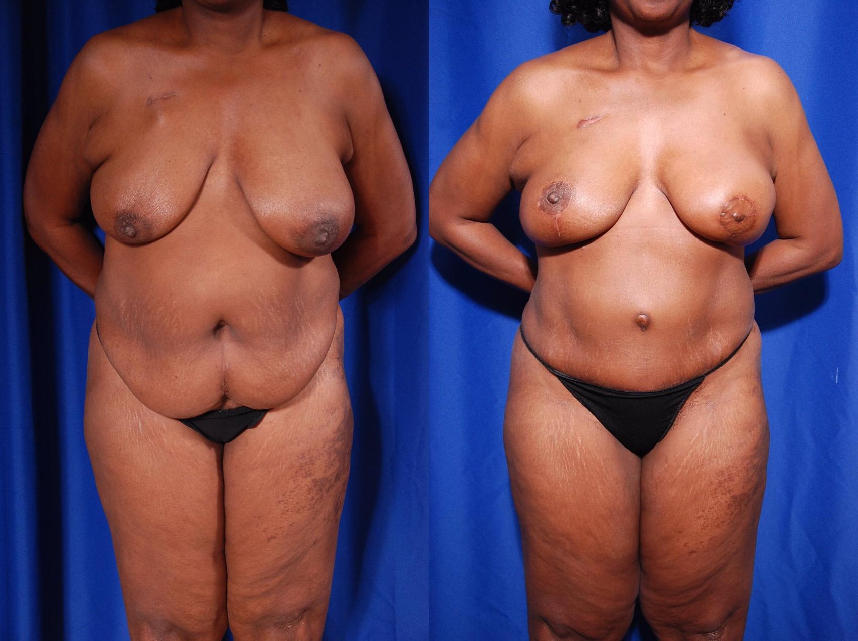 Before & After Breast Reconstruction Case 118 View #1 View in Metairie, New Orleans, Covington, LA