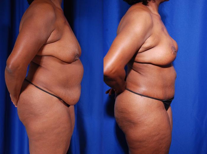 Before & After Breast Reconstruction Case 118 View #2 View in Metairie and New Orleans, LA