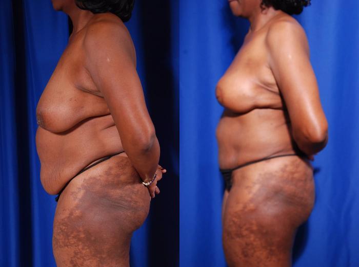 Before & After Breast Reconstruction Case 118 View #3 View in Metairie and New Orleans, LA