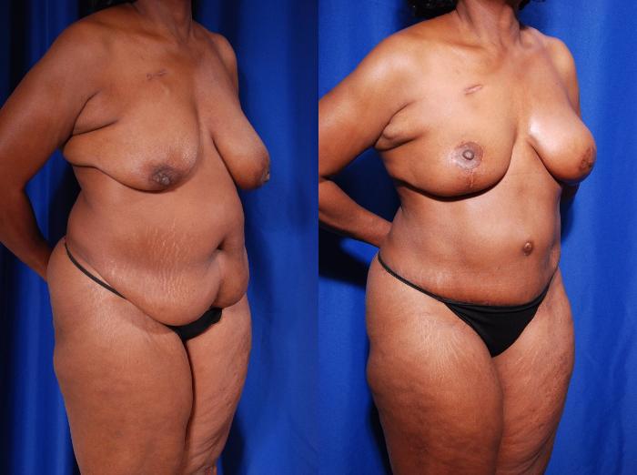 Before & After Breast Reconstruction Case 118 View #4 View in Metairie and New Orleans, LA