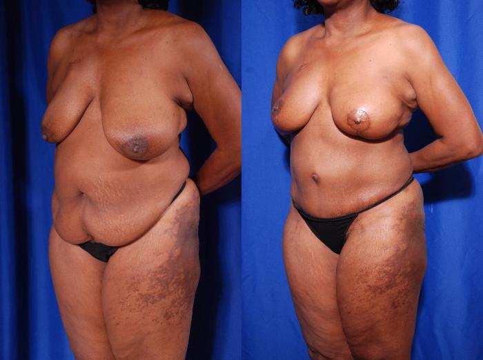 Before & After Breast Reconstruction Case 118 View #5 View in Metairie and New Orleans, LA