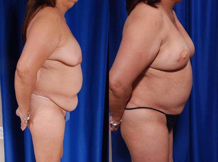 Before & After Breast Reconstruction Case 119 View #2 View in Metairie and New Orleans, LA