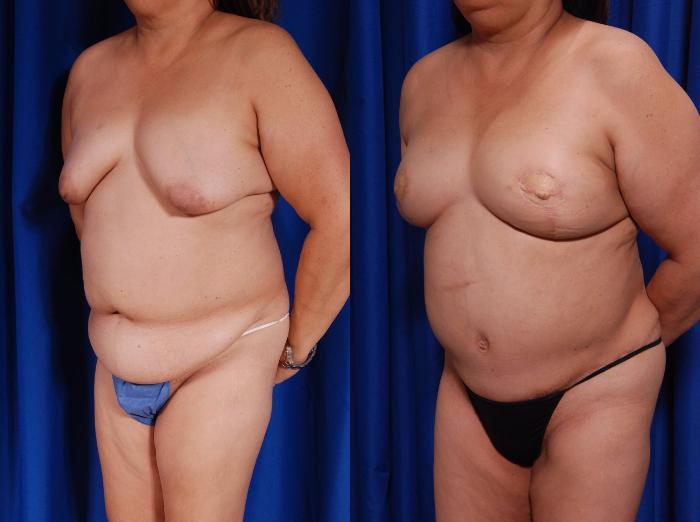 Before & After Breast Reconstruction Case 119 View #4 View in Metairie and New Orleans, LA