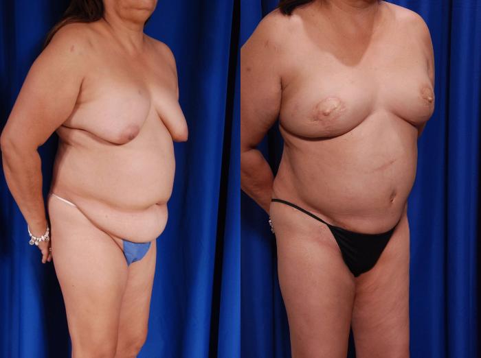 Before & After Breast Reconstruction Case 119 View #5 View in Metairie and New Orleans, LA