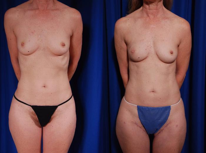 Before & After Breast Reconstruction Case 120 View #1 View in Metairie and New Orleans, LA