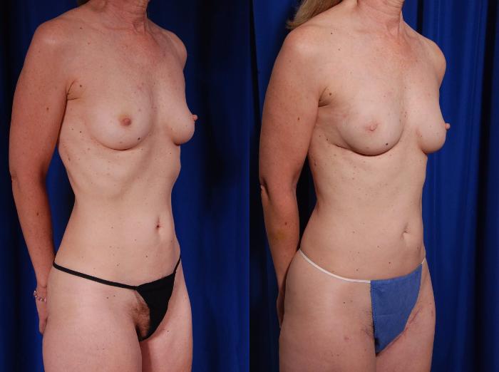 Before & After Breast Reconstruction Case 120 View #4 View in Metairie and New Orleans, LA