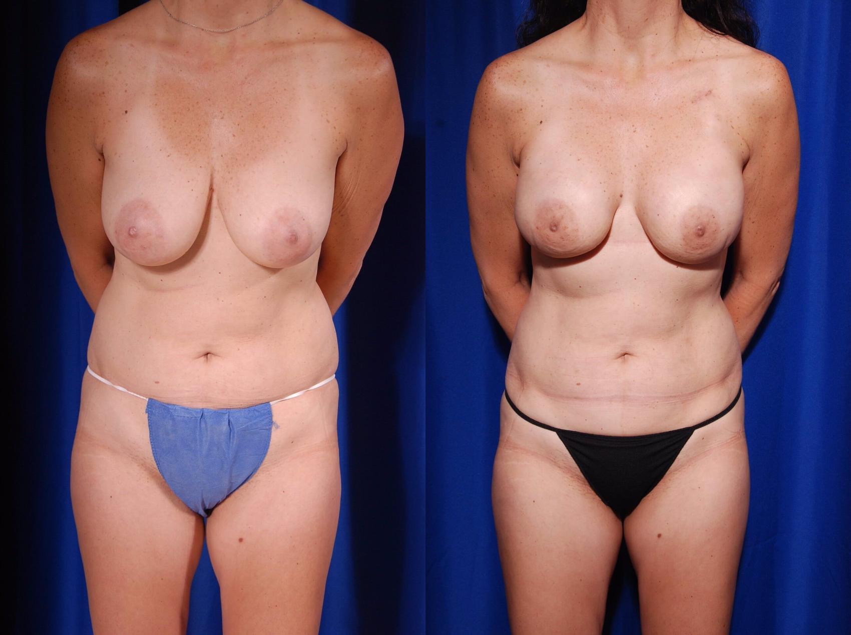 Before & After Breast Reconstruction Case 122 View #1 View in Metairie, New Orleans, Covington, LA