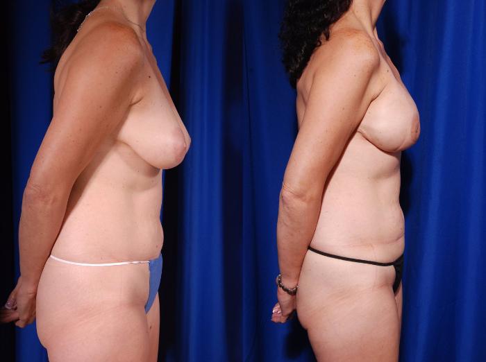 Before & After Breast Reconstruction Case 122 View #2 View in Metairie and New Orleans, LA