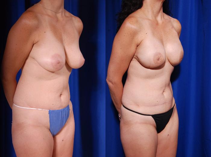 Before & After Breast Reconstruction Case 122 View #4 View in Metairie and New Orleans, LA
