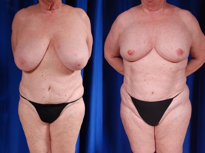 Before & After Breast Reconstruction Case 124 View #1 View in Metairie and New Orleans, LA