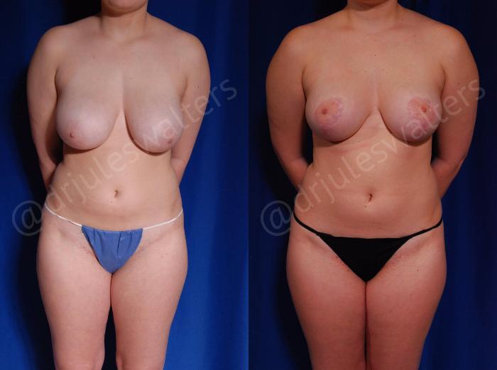Before & After Breast Reduction Case 125 View #1 View in Metairie and New Orleans, LA