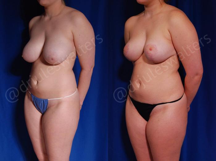 Before & After Breast Reduction Case 125 View #2 View in Metairie and New Orleans, LA