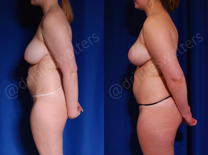 Before & After Breast Reduction Case 125 View #3 View in Metairie and New Orleans, LA