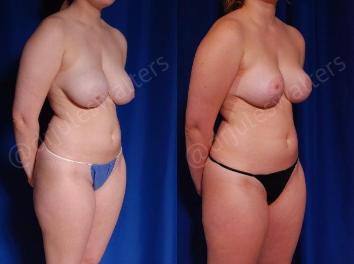 Before & After Breast Reduction Case 125 View #4 View in Metairie and New Orleans, LA