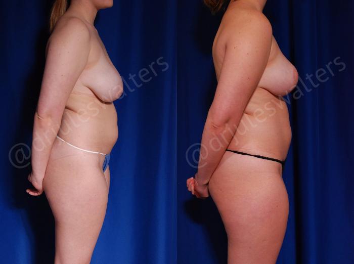 Before & After Breast Reduction Case 125 View #5 View in Metairie and New Orleans, LA